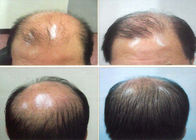 Hair Loss Treatment Drug Minoxidil Powder Cas 38304 91 5 High Purity GMP Approval